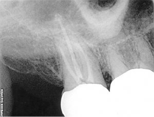 root canal from IrisDragon via flickr